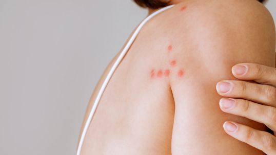 A woman scratches her shoulder bitten by a bedbug on a white background, close-up. Skin health problem. Red pimples.